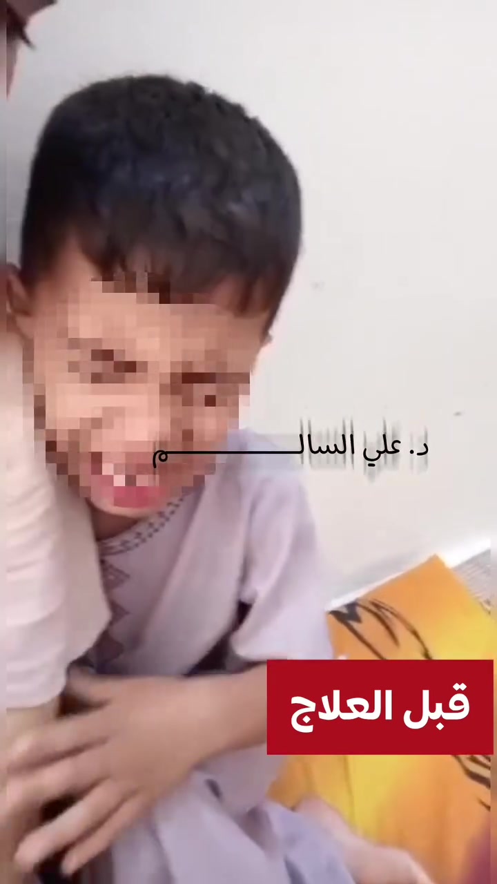من اليأس.. إلى المعجزة 

حسن حسين علي
٧ سنوات و٨ أشهر
التشخيص: توحد متوسط
المرحله العلاجيه: المرحلة الثانية

‏━━━━━━━━━━━━━━

⛔ الطريق الأول.. بلا نتيجة
مراكز التأهيل التقليدية  ٣ أشهر

❌ نطق صفر
❌ فرط حركة
❌ عصبية
❌ انتقائية أكل
❌ تكرار سلوكي

النتيجة: صفر تحسن.

‏━━━━━━━━━━━━━━ 

✅ الطريق الثاني.. الذي غيّر كل شيء
العلاج الحيوي: العصبي — المناعي — الهضمي

يعالج الجذور لا الأعراض

النتيجة بعد العلاج:
✅ فرط الحركة اختفى
✅ العصبية اختفت
✅ انتقائية الأكل اختفت
✅ التكرار السلوكي اختفى

تحوّل كامل الحمد لله

‏━━━━━━━━━━━━━━

شكراً د. علي سالم
الفضل لله أولاً.. ثم لك
كنت السبب في إعادة الأمل لهذه الأسرة

لكل أب وأم إذا جربتم كل الطرق بلا نتيجة هناك طريق مختلف حقيقي مثبت

لا تفقدوا الأمل

‏━━━━━━━━━━━━━━

‏
‏#د_علي_السالم 
‏#التوحد #توحد 
‏#حجوزات #الحجز #حجز  
‏#اللوكوفورين #لوكوفورين #علاج_ترمب  
‏
