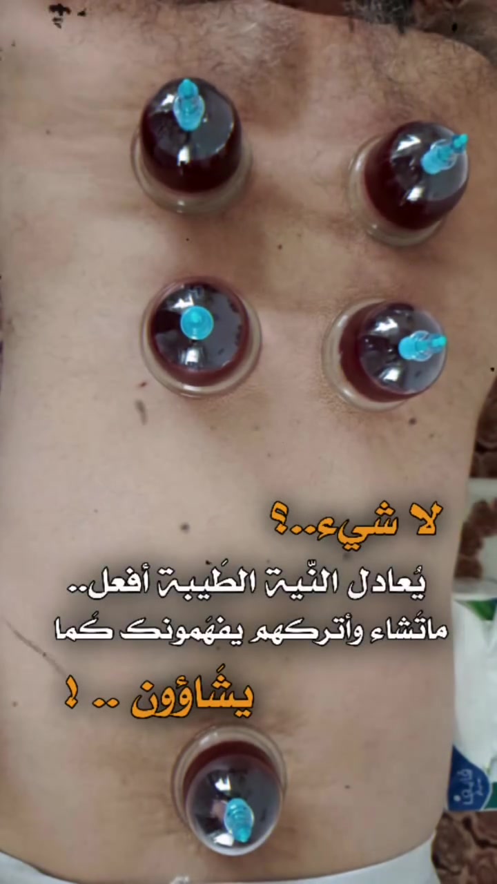 الحجامة النبوية • معقمة • علاج الصداع