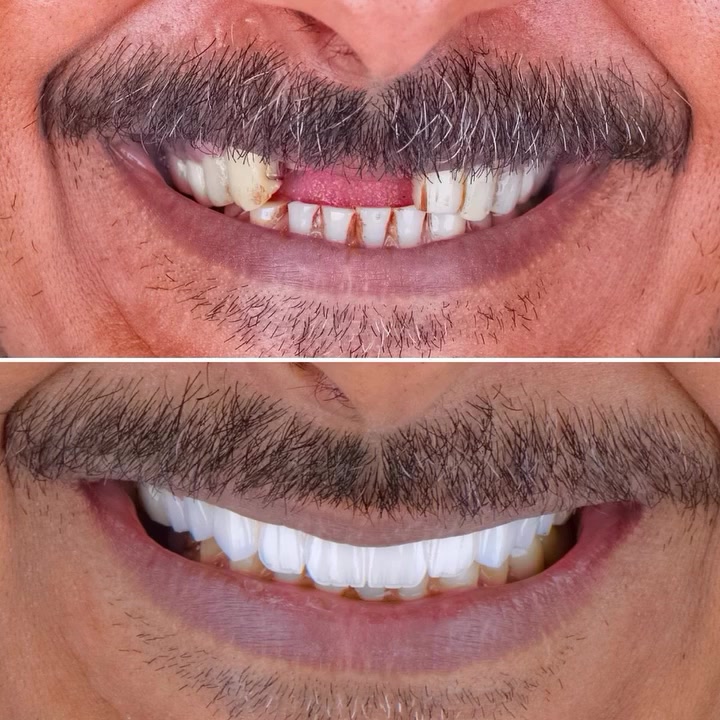 تغاليف تجميلية • ترميم أسنان • مركز الفردوس