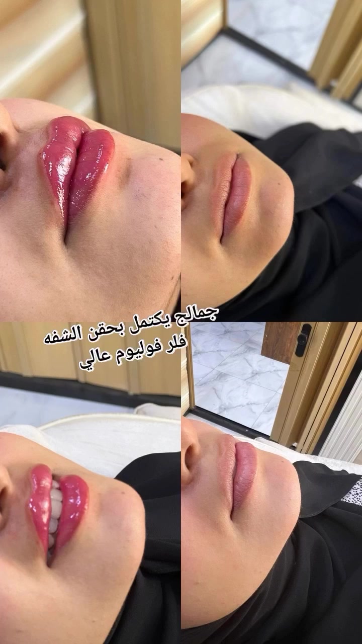 قسم الليزر • تجميل عرائس • الحسينيه شارع ابو سمير