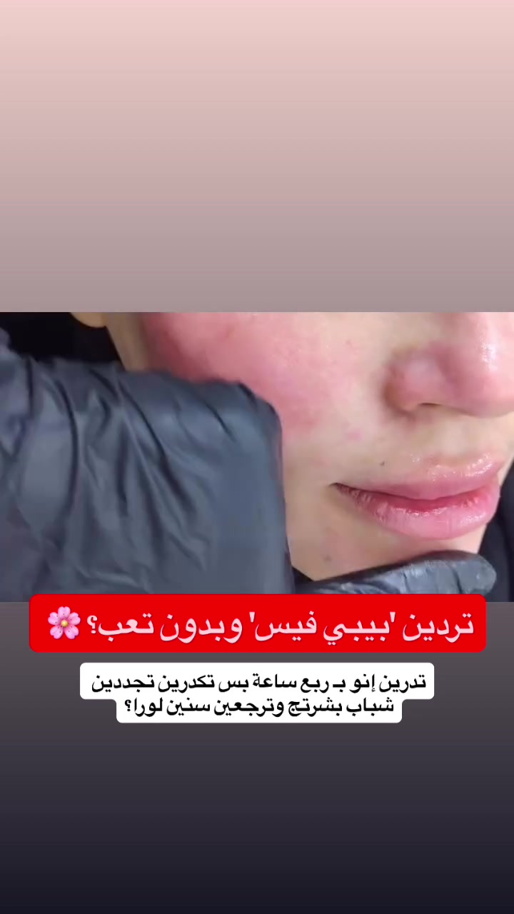بوتوكس • فيلر • نضارة طبيعية