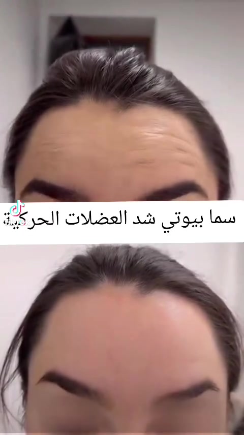 سما بيوتي • تجميل لاجراحي • بوتوكس فيلر