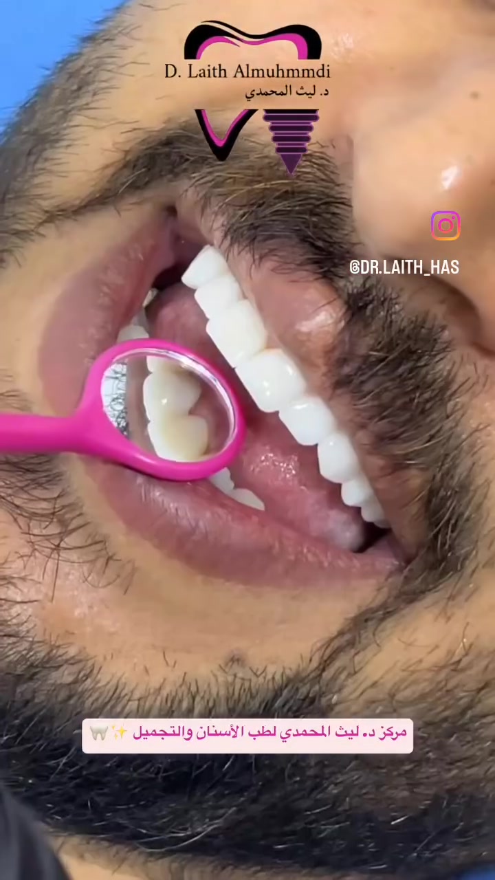 ✨😁 ابتسامة المشاهير تبدأ من هنا!
ابتسامة مرتبة، ناصعة وطبيعية… لأن ابتسامتك هي أول شيء يلفت الانتباه 🤍

✨ ابتسامة المشاهير
✨ زيركون
✨ تصميم ابتسامة يناسب ملامح الوجه

📍 عيادة د. ليث المحمدي لطب وتجميل الأسنان
الفلوجة – الجغيفي الثانية
قرب صيدلية المركز – مقابل قاعة الجوهرة

🗓️ السبت | الاثنين | الأربعاء | الجمعة
⏰ 10 صباحًا – 10 مساءً
