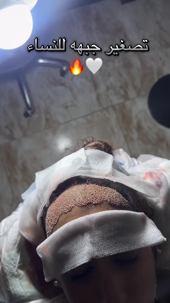 تصغير الجبهة • زراعة الشعر • بغداد المنصور