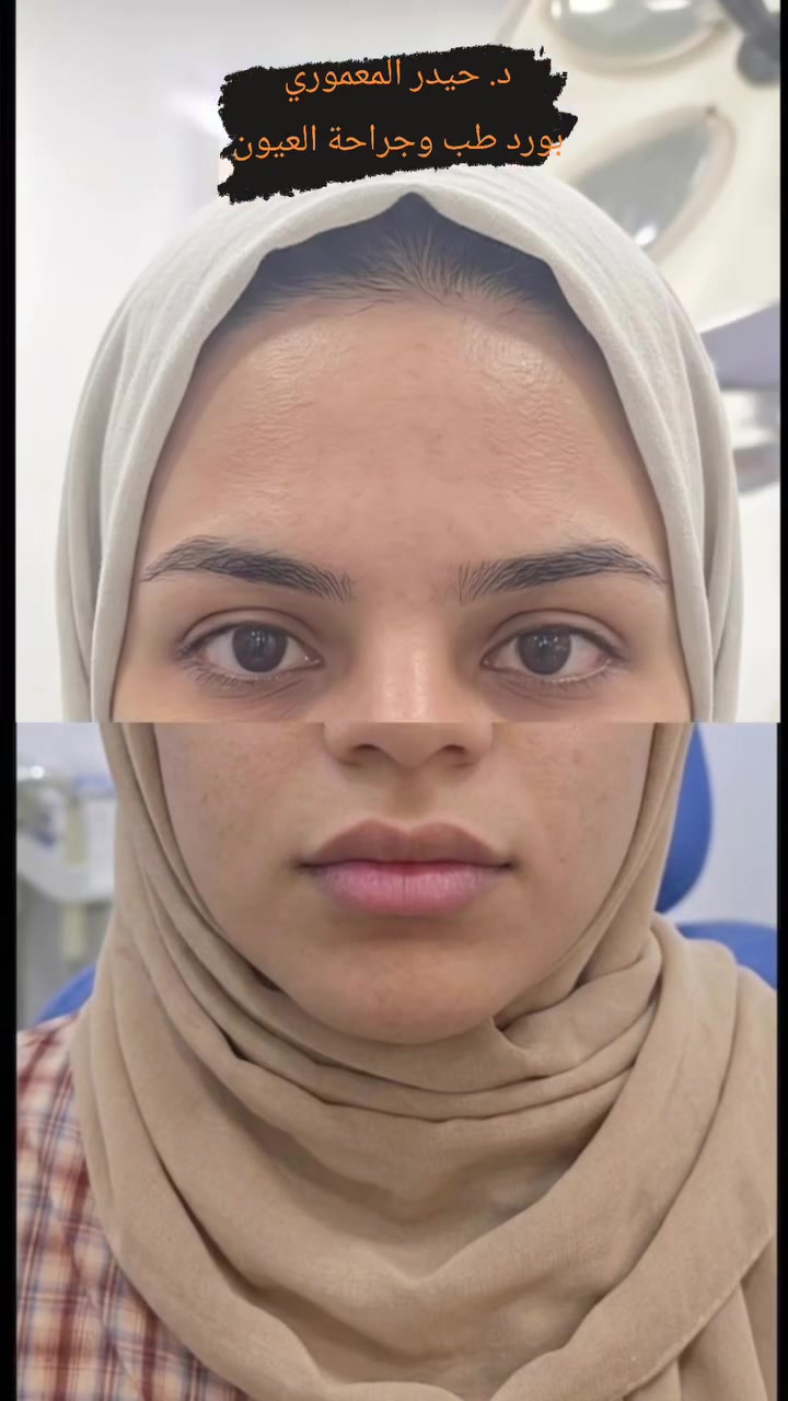 الحمدلله الذي من على مرضانا بالشفاء والنتائج المفرحة

عملية تعديل #حول انسي ( داخلي)

النتيجة بعد العملية بشهر تقريبا

__

#ملاحظة: تم أخذ الاذن من ذوي المريضة بنشر الحالة

ونسأل الله الصحة والسلامة لجميع المرضى 

🔴 نتواجد في العيادة جميع ايام الاسبوع عدا الاحد والجمعة عطلة العيادة🔴 

#الدكتور_حيدر_محمد_فياض_المعموري
عنوان العيادة : مجمع عماد الخير الطبي- مقابل مستشفى المسيب العام
للحجز والاستفسار: 
اتصال او واتساب على الرقم 📞  📱 ☎️ 
 ***********

 #المسيب #مسيب #بابل #صحة #طبيب_عيون
