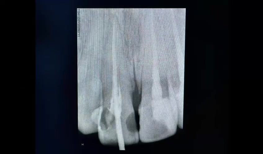 حشوات جذر, بناء الاسنان, تيجان الزركون.

عيادة د.عمار عزيز لطيف 👨‍⚕️💗
بغداد / رحمانية الشعله / عمارة الوليد 
للإستفسار الاتصال على 
***********
***********
https://wa.me/message/OIFRKEMRDTF5D1
