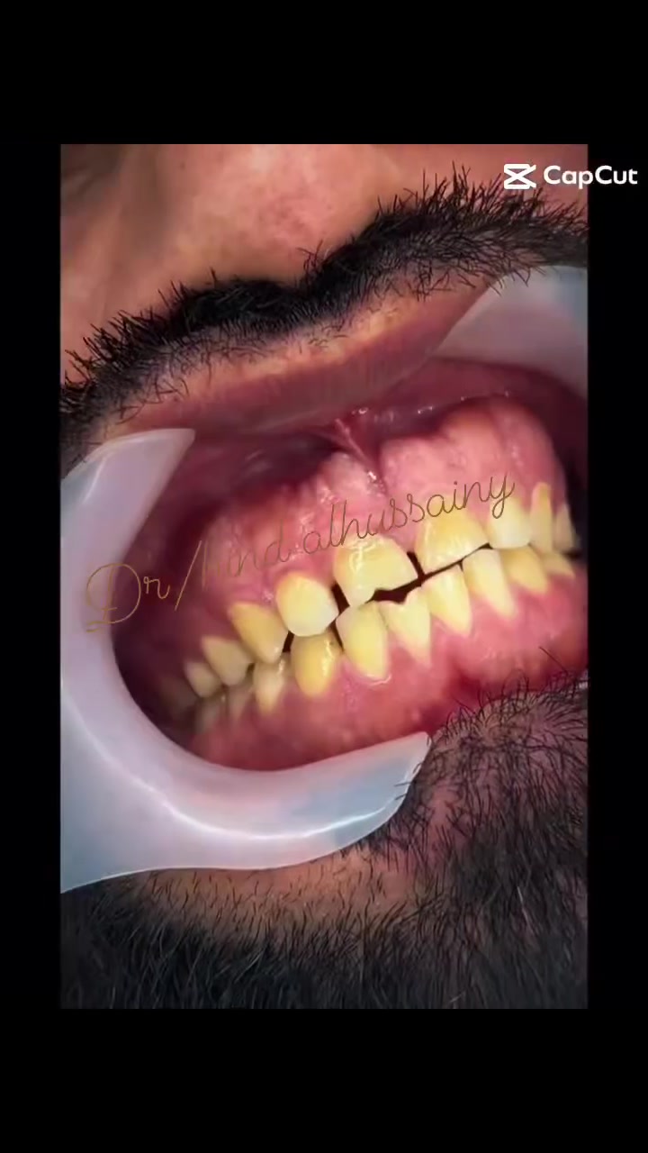 باسعار تنافسيه 🦷✨ ابتسامتك تفرق… وخلي أسنانك بأيدٍ تهتم بالتفاصيل 🤍

قسم الأسنان متوفر بيه:
✨ تنظيف وتبييض الأسنان
✨ حشوات تجميلية
✨ فينير كومبوزت وزاركون
✨ علاج العصب والقلع
✨ تقويم الأسنان
✨ علاج أسنان الأطفال

📍 بغداد – الأمين الثانية – النواب – شارع المهداوي
📞 ***********

د. هند الحسيني 🩷
