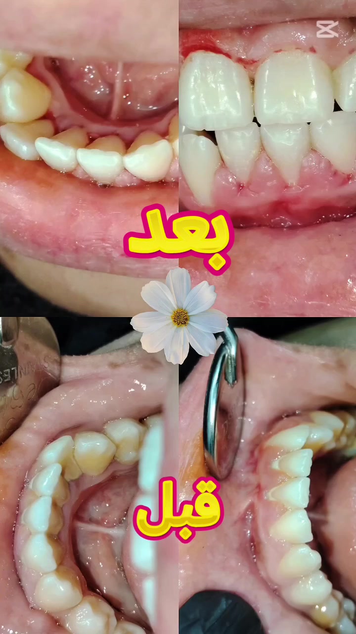 تنظيف الأسنان • إزالة الجير • مجمع ابن حيان
