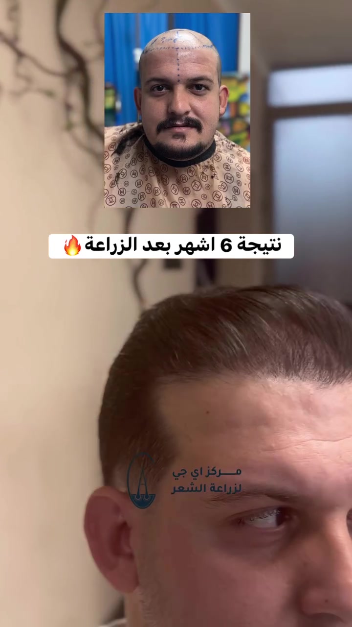 🌱 استعد لشعر أكثر كثافة وثقة من جديد!
زراعة شعر بجلسة واحدة وبنتائج طبيعية ✨

📍 بغداد – الحارثية
📞 ***********
احجز موعدك الآن!
