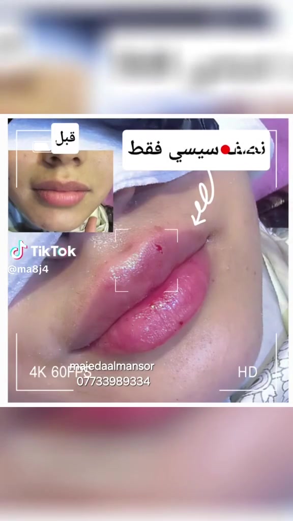 ✨ لأن جمالچ يستاهل الاهتمام ✨
💋 فيلر بايدي الدكتورة ماجدة المنصور Jojo Alnabeel 
لإبراز ملامحچ ومنحچ إطلالة مرتبة وطبيعية
💎 إبرة نضارة
لإشراقة ونضارة وترطيب البشرة
🌸 خليچ دائماً بأجمل إطلالة
العنوان بغداد الحسينية مقابل السوق الكبير مجاور مرطبات العذراء مجمع سما الحسينية الطبي الطابق الثاني 
📍 الحجز مسبقاً 
📞***********
