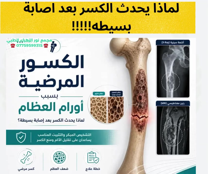 جراحة العظام • كسور مرضية • بغداد المشتل