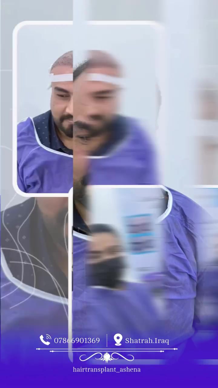 الله تبارك الرحمن
هاي النتيجة بعد 7 أشهر بس من زراعة الشعر
تغطية كاملة للفراغات، وخط أمامي طبيعي 100% ما يبين مزروع
الصور قبل وبعد هي اللي تحجي
اذا تعاني من الصلع الوراثي او الفراغات، تواصل ويانا والاستشارة مجانية
#زراعة_الشعر #زراعة_الشعر_في_العراق #زراعة_الشعر_الناصرية #زرع_الشعر #علاج_الصلع قبل_وبعد الناصرية بغداد البصرة تجميل_العراق
