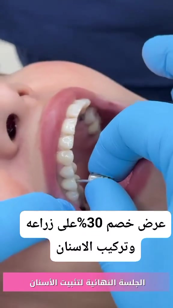 زراعة أسنان • أقساط • عيادة أحمد الجنابي