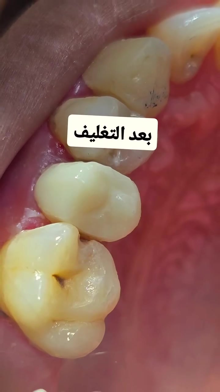 اعادة تأهيل الاسنان التالفه بتغليفات الزاركون👌🏻✨️
عيادة المسك لطب الاسنان

📍بغداد – المعامل - الحسينيه - قرب فلكة الشهداء - مجمع المسك الطبي

☎️ للحجز والاستفسار يرجى مراسلة الصفحه أو الاتصال على الرقم التال ***********
