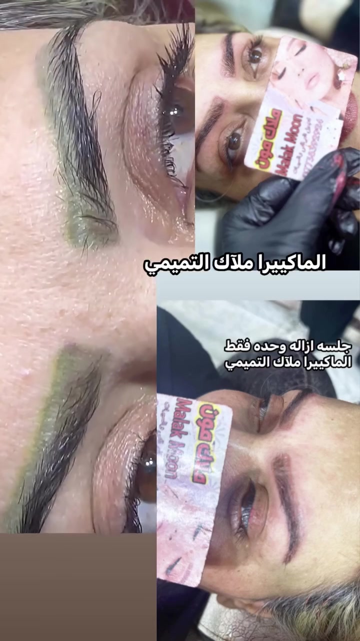نتيجة الازالة قبل وبعد
نحب نبشر زبونتنا  جلسة الشعيرات راح تكون مجانيه هدية الها من المركز

وأي صبية توافق على التصوير راح يكون الها شغل مجاني 
ونكول للزبونه ألف عافيه 

تابعوا راح ننشوار حواجبها بعد متكمل الازاله والشعيرات 

للحجز مراسلة الصفحة او الأتصال على الرقم 
***********

موجود واتساب 

اعذورنه على الصوت ست ملاك تعبانه وصوتها تعبان خطيه  من الجو ساعه حار ساعه بارد. 😆🤣 #جمال
 #عروض
 #تغيير
 #هاشتاك
