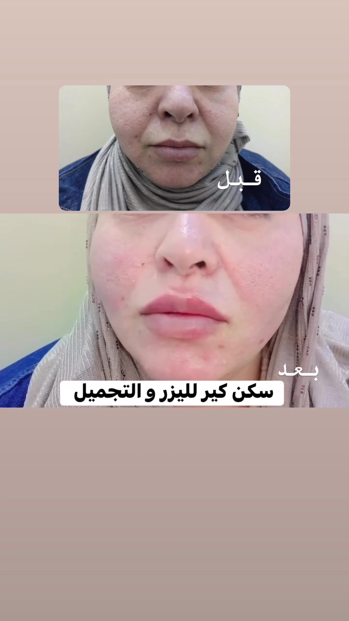 @إشارة سكن كير لليزر والتجميل عيادات الرحمة الطبية المروجة بيان عيادة سكن كير للتجميل مختبر الرحمة الطبي  مجمع ابو تراب الطبي الخيري سكن كير Ali Dawood  إمرأة فبراير Alaa Alwaale فہٰٰٛﹻيہٰٰٛﹻۈبآﺂ ۦۦۦ، @
  ✨ الخيوط الذهبية للوجه ✨

لإطلالة أكثر نضارة وشبابًا، تمنحك الخيوط الذهبية دعمًا للبشرة وتحفيزًا لإنتاج الكولاجين، لتساعد على تحسين مظهر الترهل والخطوط الدقيقة والحصول على بشرة أكثر حيوية ✨

💛 نضارة وإشراقة
💛 شد وتحسين مظهر البشرة
💛 تحفيز الكولاجين
💛 إطلالة طبيعية وأكثر شبابًا

📩 احجزي موعدك الآن واستشيري المختص لمعرفة ما إذا كانت التقنية مناسبة لبشرتك.
سكن كير لليزر والتجميل 
***********

