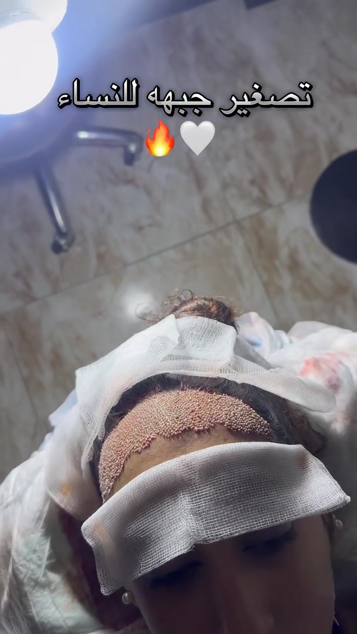 تصغير الجبهة • زراعة الشعر • المنصور