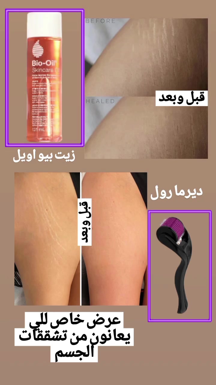 هل تزعجك علامات التمدد والتشققات؟ الحل أصبح بين يديكِ! ✨
​نقدم لكِ العرض السحري لعلاج مشاكل بشرة الوجه والجسم، والذي يجمع بين قوة الطبيعة والابتكار في روتين واحد:
​🌟 زيت بيو-أويل (Bio-Oil): الغني بالفيتامينات والزيوت الأساسية لترطيب عميق، توحيد لون البشرة، وتقليل مظهر الندبات وعلامات التمدد بفعالية مثبتة.
🌟 ديرما رولر (Microneedling): الأداة الاحترافية التي تعمل على تحفيز إنتاج الكولاجين وتجديد خلايا البشرة، مما يعزز من امتصاص الزيت ويسرع النتائج بشكل مذهل.
​📸 شاهدي النتائج المذهلة (قبل وبعد) في الصورة! 📸
احصلي على بشرة ناعمة، مشدودة، وأكثر نضارة.
​🛒 اطلبي العرض الآن ولا تفوتي الفرصة!
***********:
​#عناية_بالبشرة
#علامات_التمدد
#بيو_أويل
#ديرما_رولر
#علاج_التشققات
#قبل_وبعد
#جمالك
#سكين_كير