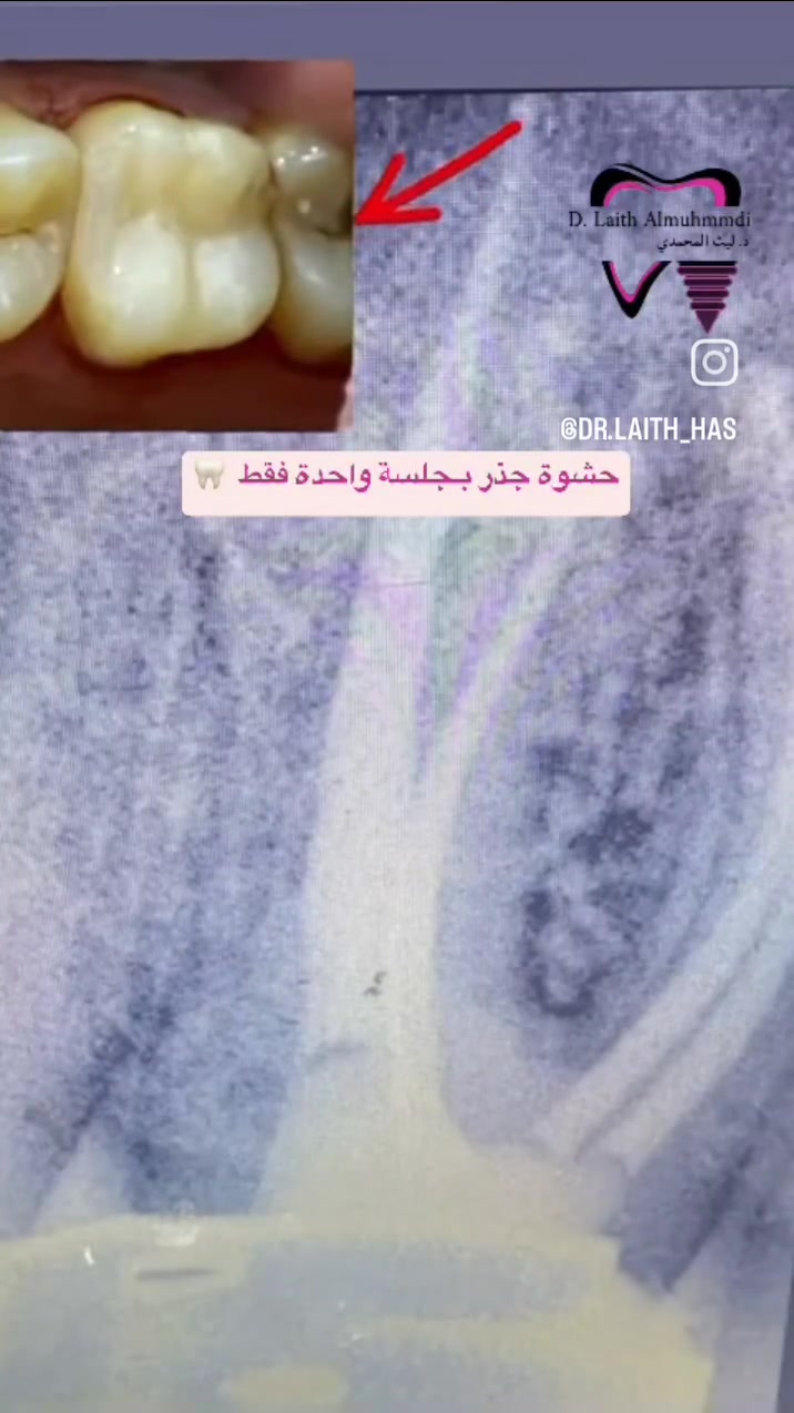 🦷✨ حشوة الأسنان بجلسة واحدة!
عندك تسوس أو ألم بالسن؟ لا تهمل المشكلة، لأن العلاج المبكر يساعد على الحفاظ على السن وتجنب تفاقم التسوس.

✨ حشوة الأسنان
✨ علاج التسوس
✨ حشوات تجميلية بلون الأسنان
✨ إنجاز الحالة بجلسة واحدة حسب تقييم الطبيب

📍 عيادة د. ليث المحمدي لطب وتجميل الأسنان
الفلوجة – الجغيفي الثانية
قرب صيدلية المركز – مقابل قاعة الجوهرة

🗓️ السبت | الاثنين | الأربعاء | الجمعة
⏰ 10 صباحًا – 10 مساءً
