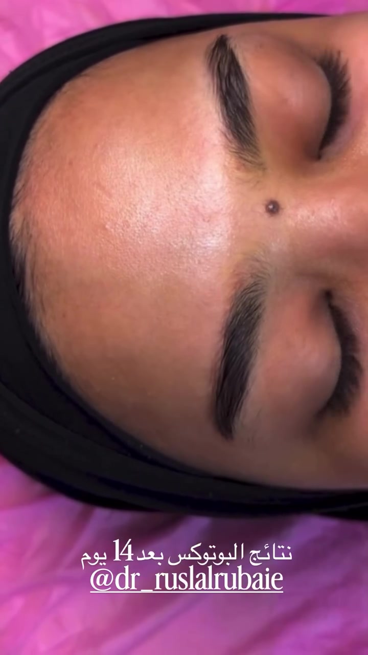 عروض شهر التاسع
مراجعاتي  الحلوات ورأيهم صوت وصوره ماشاءالله الفرق ديشوفو من اول الجلسات لان الاختيار يكون مو عشوائي كل مراجعة نختارلها مكس او ابرة خاصة لحالتها💉💗💗👏 وهو هذا الشغل الصح الي يخليكم تشوفون فرق من الجلسة الاولى 💉🍓

بخصوص العروض مراح تتكرر بعد ابداً لان اقوى عروض سويناهه 

خلال شهر التاسع واقبالكم عليه جداً عالي 💉👏

بخصوص كل المواد الجديدة الي تنزل داخل العياده تكدرون تتابعون صفحة الانستكرام 

https://www.instagram.com/p/DbWWdUhsNAt/?stkn=Z2EwenVjcm5rOXFu

او صفحتنا على الفيسبوك DrRusl Alrubaie

او مراسلتنا واتساب مسج فقط ***********

نص مكتوب في الصور:
- نتائج استمرار المراجعة بحقن ابر النضاره شهريا 0 ماشاء الله تلمع 🤭 ✨✨ وهذا السر الي يخليكم تشوفون فرق لان اختيار الابره يكون حسب الحالة ✨ @DrRusl_Alrubaie
- @dr_Ruslalrubaie
- Before @dr_ruslalrubaie After
- متواجدة دكتورة اهلا حبيبتي نعم متواجدة 9:44 AM مرحبا دكتورة دكتور تقطيع ألياف الحالة شكد PM مراحب حبيتي You replied ما شاء الله حالة مراجعتي تعاني من ندب ومسام واسع بسبب اثار حب الشباب بججلستين بس حصلت نتيجة دكتور تقطيع ألياف الحالة شكد شلونها حالتي بعد الجلسة? Replied to you شلونها حالتي بعد الجلسة? تجنن دكتورة DrRusl Alrubaie@ يعني ميحتاجلي شي بس ضل شوية يعني كولش بسيط اثر شوية سطحي أما المسام كولش صغر Message...