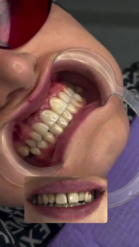 مركز ماسة الحسينية التخصصي لطب وجراحة الفم والأسنان 

تغيير بسيط بأسنانك يقدر يغير شكل ابتسامتك بالكامل!
احجز موعدك اليوم وابدأ رحلة الابتسامة المثالية مع مركزنا

🏢 العنوان: بغداد - الحسينية - شارع ٢٠ (مجاور السوق الصغير)
📲 للحجز والاستفسار: ***********
🗓 متواجدين طيلة أيام الأسبوع
#مركز_ماسة_لطب_وتجميل_الاسنان
