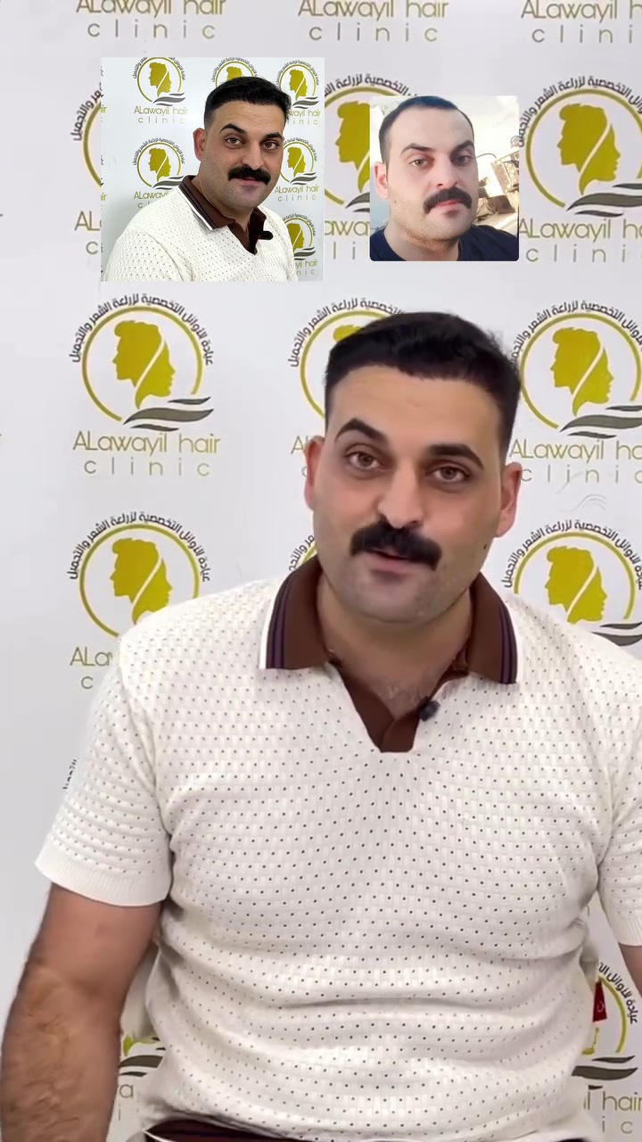 🔥الأوائل لزراعة الشعر خيارك الأفضل 

# زراعة بصيلات عدد مفتوح 
عرض الاوائل لفتره محدوده 
زراعة_بصيلات عدد مفتوح بضمان مدى الحياة
العيادة  الاولى على العراق بزراعة الشعر بكادر طبي متخصص

. زراعة شعر الرأس بتقنية الاقتطاف (FUE).
. زراعة اللحية والشارب.
. زراعة الحواجب.
. استشارة وتقييم حالة الصلع قبل العملية.
. متابعة المريض بعد العملية مع تعليمات العناية والغسل 
. ٦ جلسات بلازما مع ميزو 
. حقيبه علاجيه متكامله بعد العمليه 
تحاليل قبل العمليه مجانا

📍 عيادة الأوائل  لزراعة الشعر – النجف الأشرف

📞 للحجز والاستفسار: ***********
📩 راسلونا أو زورونا لحجز استشارتكم”

#viral #exploer #اكسبلورexplore #fypage
