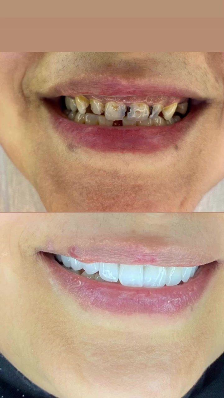 ✅❤️🦷جزء من بعض الحالات التي تمت معالجتها بعيادتنا بالتركيب والتغليف الثابت 

📌استخدام الطبعه الرقمية بدل الطبعه التقليدية 
📌تعامل مع أرقى المختبرات لصنع الاسنان 
📌 أسعار مناسبة 
📌 سرعه الشغل وجماله
——————❤️—————❤️——
الحله/ حي الامام علي/ بدايه شارع الكابينات /مقابل كرار ابو الكص 
علما بأن العياده تعمل بنظام الحجز المسبق فقط
سارعوا بالحجزواتساب ***********
#اسنان #ابتسامه
