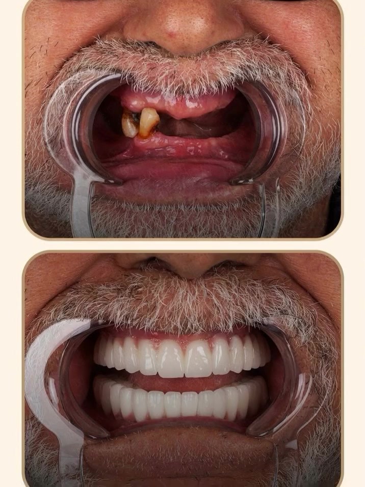 🦷✨ عوّض أسنانك المفقودة واستعيد ابتسامتك بثقة مع زراعة الأسنان، لتستمتع بمظهر طبيعي ووظيفة أفضل لأسنانك.

📍احجز موعدك واستفسر عن التفاصيل.
متواجدين طيلة أيام الأسبوع 
العنوان/القرنة/شارع المستوصف/عمارة شركة بغداد للحاسبات/للأستسفار/***********
