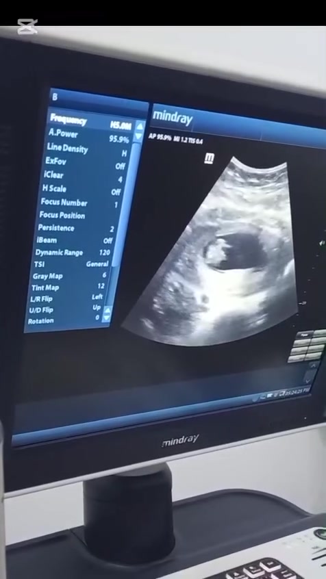 نُشارك اليوم فرحة مريضتنا الغالية 🤍
بعد انتظارٍ دام 4 سنوات، أكرمها الله ببشارة الحمل، لتكتمل فرحتها بمعرفة جنس الجنين: ولد 💙
فرحة طال انتظارها… وحلم أصبح حقيقة بفضل الله 🤲🏻
نسأل الله أن يتمّم حملها على خير، ويرزقها مولودًا سليمًا معافى 

🌿الدكتورة ميس باقر سفاح الميالي
اختصاص نسائية وتوليد ورعاية الحوامل
سونار حديث ودقيق
📞 للحجز والاستفسار: ***********
📍 ذي قار – قضاء الفجر – شارع الصيدليات – مجاور مخبز سويح شجر
