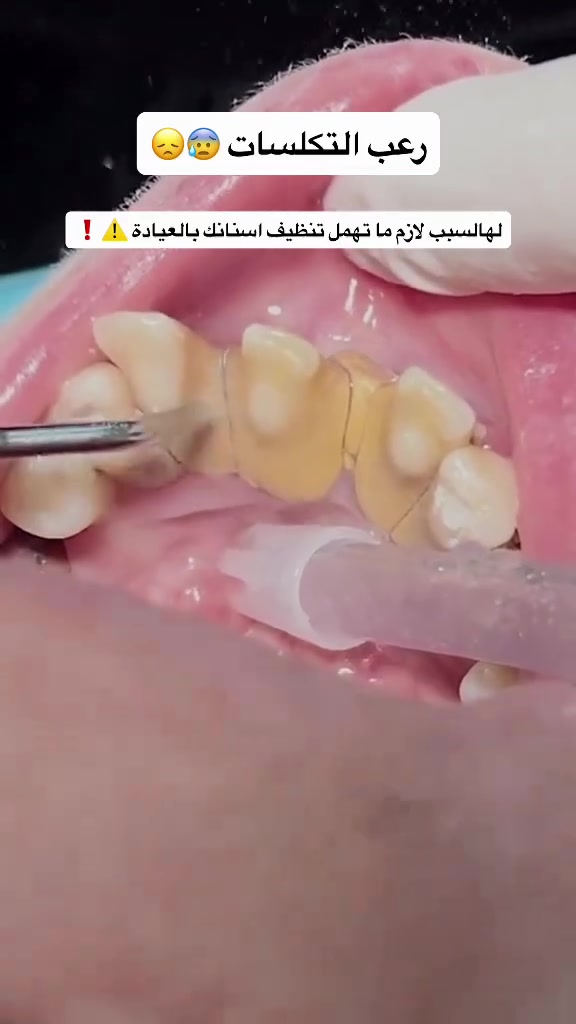 تنظيف الاسنان بجلسه واحده تحل كل مشاكلك👌🏻

📍بغداد – المعامل - الحسينيه - قرب فلكة الشهداء - مجمع المسك الطبي

☎️ للحجز والاستفسار يرجى مراسلة الصفحه أو الاتصال على الرقم التال ***********
