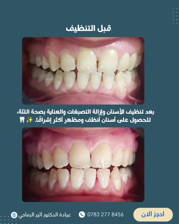 🦷✨ تنظيف الأسنان مو رفاهية
 بل خطوة أساسية للحفاظ على صحة الأسنان واللثة وتقليل تراكم الجير والتصبغات.🫰 

  عيادة د. أثير حليم الرماحي
  لطب وتجميل الأسنان 

☎️ للحجز والاستفسار: ***********
أو مراسلة الصفحة

📍 الديوانية – قضاء عفك / شارع الأطباء
قرب صيدلية أكرم البديري، بناية د. مهند علي الجبوري، الطابق الثاني

#ابتسامتك_تستحق_الأفضل #عيادة_اسنان #تنظيف_الاسنان
#حشوات_تجميلية_حشوات_جذور_تركيب_اسنان_ثابتة_ومتحركة_تبييض_اسنان_بالليزر_ابتسامة_المشاهير #اكسبلورexplore
