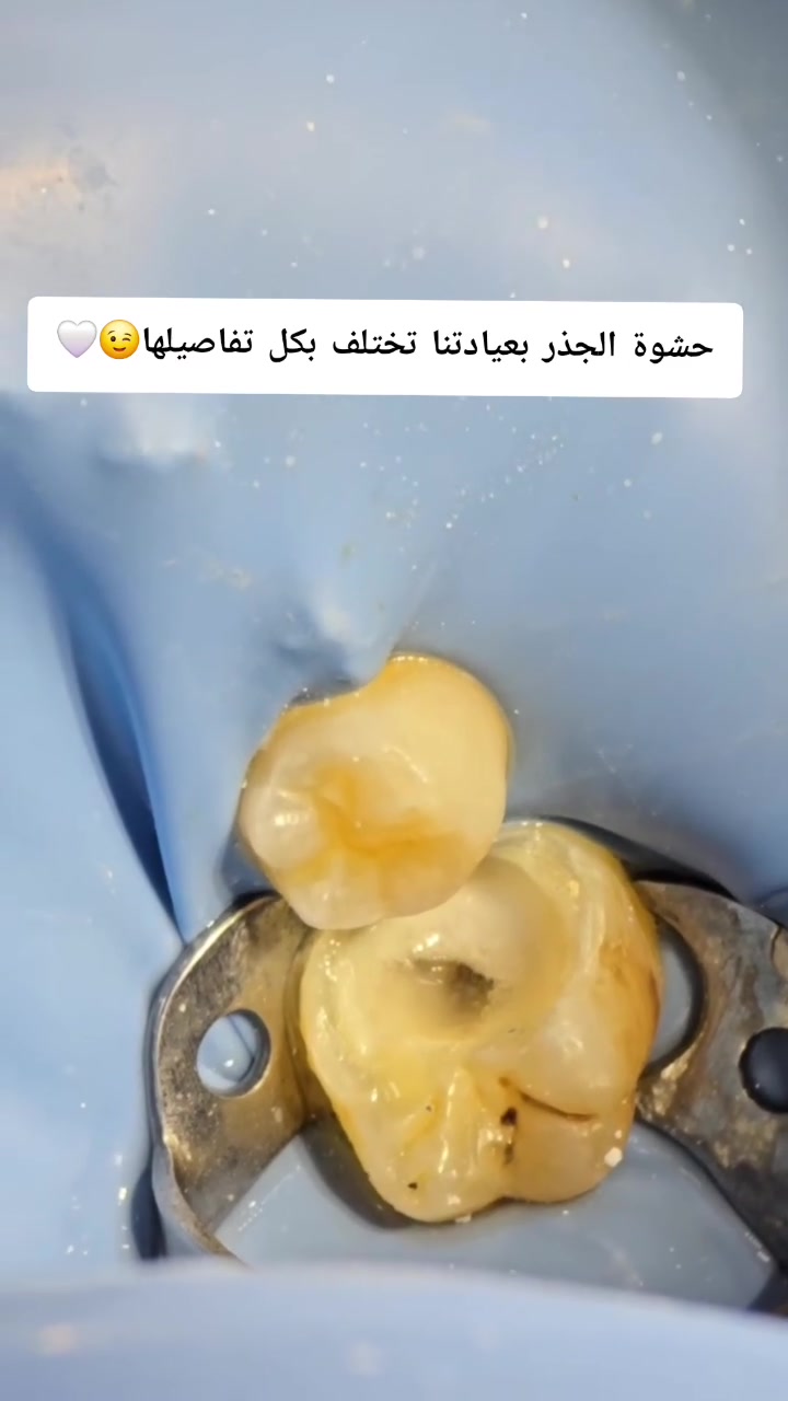 طريقة عمل حشوة الجذر داخل عيادة المسك

العنوان// حسينية المعامل _ قرب فلكة الشهداء _ داخل مجمع المسك الطبي
☎️ للحجز والاستفسار يرجى مراسلة الصفحه أو الاتصال على الرقم التالي ***********
