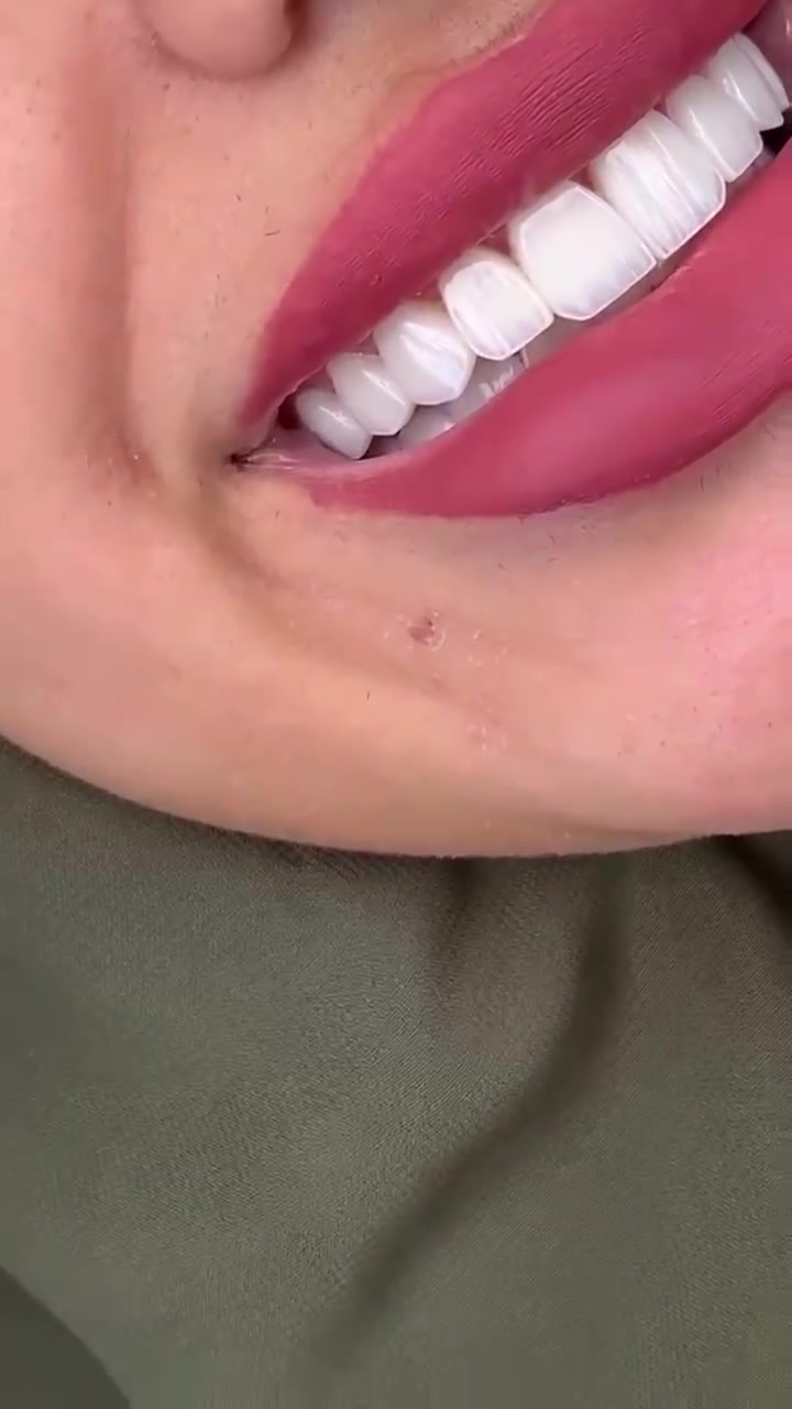 سما الفاو • تجميل أسنان • ابتسامة هوليود