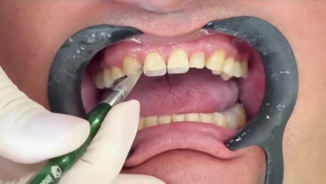 ابتسامة أجمل تبدأ بتفاصيل بسيطة 🦷✨

في هذه الحالة قمنا بإعادة تصميم شكل الأسنان الأمامية باستخدام الحشوات التجميلية بتقنية الفينير المباشر، مع اختيار اللون والشكل بما يتناسب مع ملامح الوجه والابتسامة.

تمت معالجة العيوب وتعديل شكل الأسنان وإغلاق الفراغات، مع الحفاظ قدر الإمكان على بنية الأسنان الطبيعية، للحصول على ابتسامة متناسقة وطبيعية وبلمسة جمالية مميزة 🤍

📍 العنوان شارع 13 مقابل عيادة الدكتور علاء (اخصائي السونار)
☎️ رقم الحجز ***********
#فينير_مباشر #حشوات_تجميلية #ابتسامة_هوليود #تجميل_الأسنان #CompositeVeneers #DirectVeneers #DentalEsthetics
