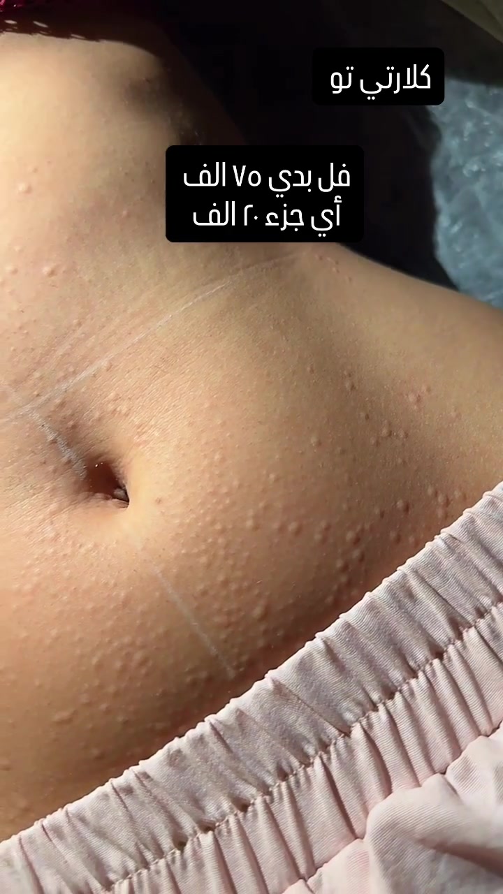 ⁨ عرض الليزر نهاية الصيف فل بدي 75 الف 
أي جزء 20 الف 

راسلونا للحجز 
***********
#اكسبلور_فولو⁩
