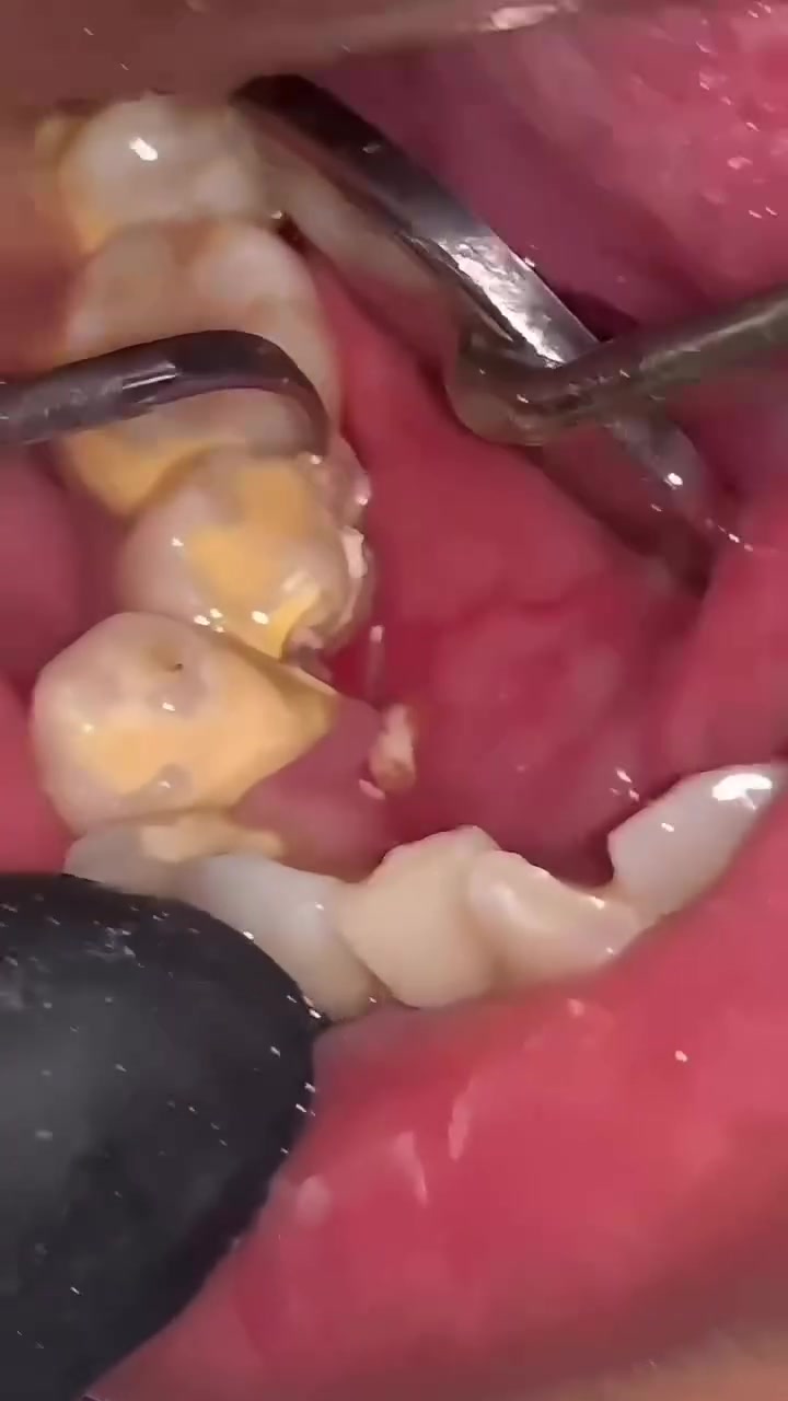 نستقبل مراجعين لإجراء بعض العلاجات السنية مجاناً ✨
🔹 إزالة التكلسات وتنظيف الأسنان

🔹 حشوات الأسنان التجميلية

🔹 علاج تسوس الأسنان

🔹 قلع الأسنان عند الحاجة

🔹 فحص وتشخيص حالة الأسنان واللثة

🤍 الخدمات مجانية لعدد محدود من المراجعين

📌 يتم تحديد نوع العلاج بعد الفحص والتشخيص

📍 كربلاء – شارع الحر الصغير – جامعة أهل البيت

📞 للحجز والاستفسار واتساب : ***********
