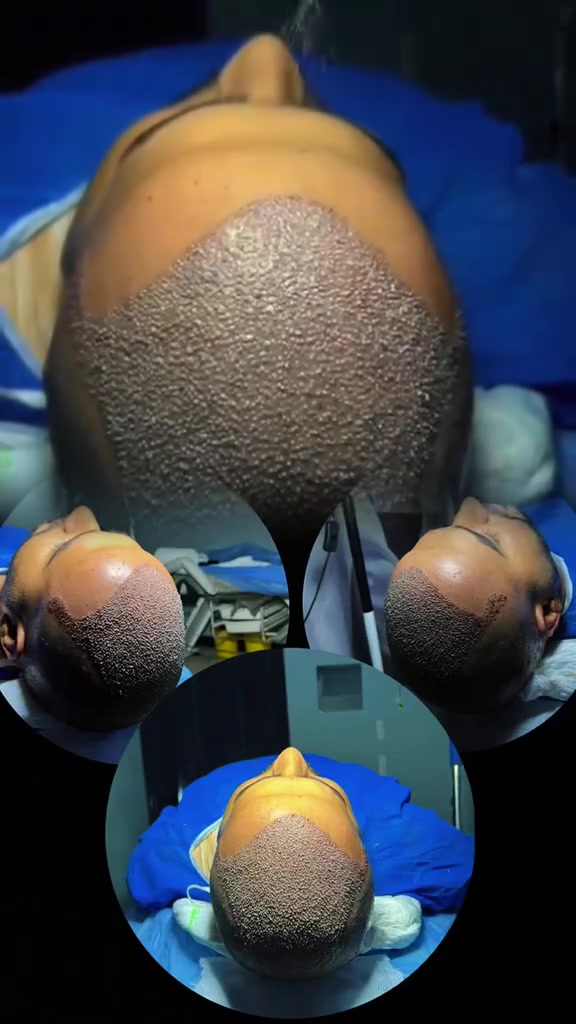 زراعة شعر • عيادة بان موسى • المنصور