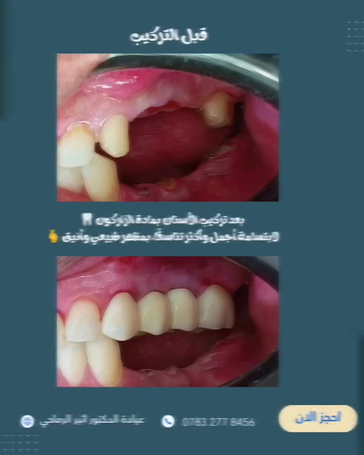 🦷✨ تركيب أسنان... ابتسامة أجمل وثقة أكبر
لأن الابتسامة الحلوة تبدأ من ابتسامة صحية ومتناسقة 🤍
نهتم بأدق التفاصيل لنمنحك نتيجة طبيعية ومريحة تناسب ملامحك.

 [ عيادة الدكتور أثير حليم الرماحي] 

☎️ للحجز والاستفسار: ***********

📍 موقعنا : الديوانية-قضاء عفك _ شارع الأطباء قرب صيدلية أكرم البديري_ بناية الدكتور مهند علي الجبوري_ الطابق الثاني

#ابتسامتك_تستحق_الأفضل #تركيبات_أسنان_زاركون #دکتور_اسنان #اكسبلورexplore #حشوات_تجميلية_حشوات_جذور_تركيب_اسنان_ثابتة_ومتحركة_تبييض_اسنان_بالليزر_ابتسامة_المشاهير
