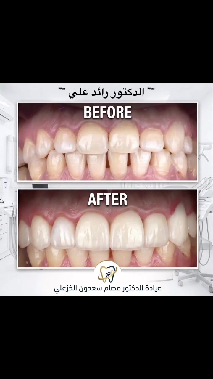 "بين الماضي والحاضر.. خيط رفيع تصنعه الخبرة واليد الماهرة! 💎
نُشارككم اليوم إحدى حالات التجميل والتركيبات التجميلية الناجحة في عيادتنا، حيث تخلصنا من عدم التناسق والفراغات لنصل إلى ابتسامة متراصة، بيضاء، ومصممة خصيصاً لتناسب ملامح الوجه بشكل طبيعي تماماً ومن دون مبالغة.
📍 عيادة الدكتور عصام سعدون الخزعلي ترحب بكم دائماً لتصميم ابتسامتكم المثالية.“”
اوقات الدوام :-
من السبت الى الخميس بااستثناء يوم الجمعه 
من الساعة 3:00 ضهراً 🕒
الى الساعة 9:00 مساءً 🕘
🔸🔸🔸🔸🔸🔸🔸🔸🔸🔸🔸🔸
📍بغداد .الحسينيه .تقاطع مسقط .مقابل منتزه الملوك 👍🏻
للحجز والاستفسار مراسلة عبر الصفحه 📪
او الاتصال ع رقم ***********📞

