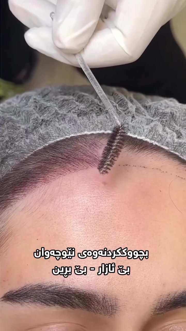 تا ئێستا تێبینی چوونه‌وە دواوه‌ی نێوچه‌وانه‌کانت کردووه‌؟  
چارەسەری ئەم حاڵەتە چاندنەوەی پرچە بۆ نێوچەوان  
بچووککردنەوەی نێوچەوان
بێ ئازار و بێ برین
نەشتەرگەریەکە کە ئەنجام دەدرێت  
ناونیشان: هەولێر شەقامی شۆڕش سەنتەری پیۆنی

***********
***********

 #doctor_hevar #چاندنەوەی_پرچ#چاندنەوەی_قژ
