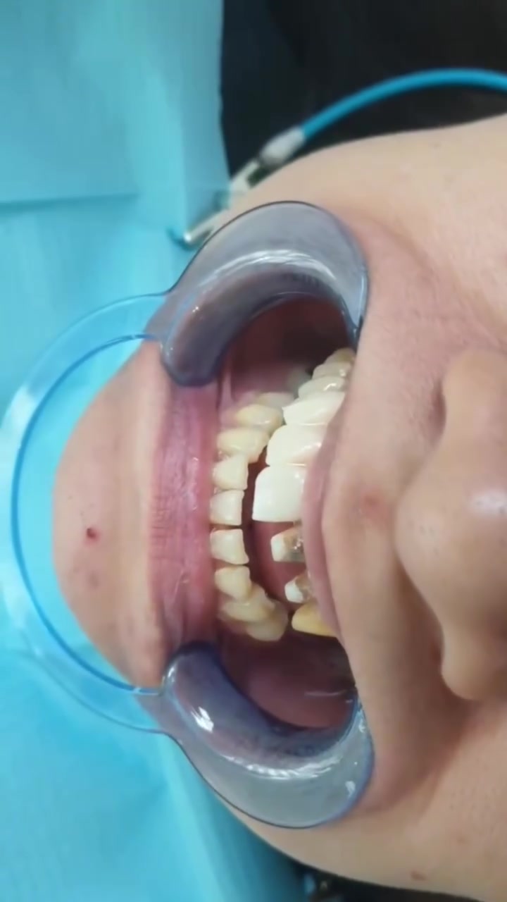 ✨ تركيب الأسنان في عيادة الدرة 🦷

ابتسامة أجمل تبدأ من هنا 🤍
تركيب أسنان بإتقان واهتمام بأدق التفاصيل، حتى تستعيد ابتسامتك وثقتك بنفسك ✨

📍 عيادة الدرة لطب الأسنان
***********
