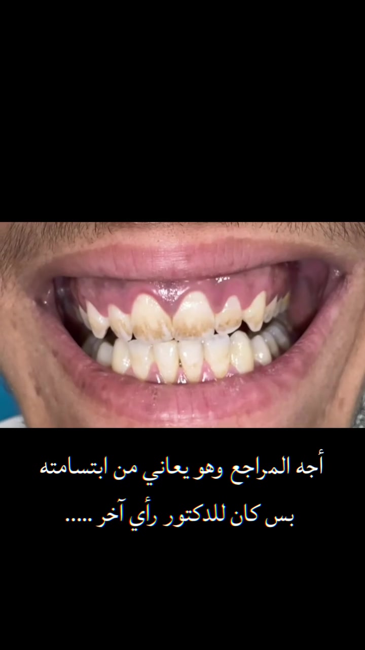 زورونا للعيادة نستقبل كل الحالات اهلا وسهلا بكم 
والاهم راحة المراجع  🤍🦷
