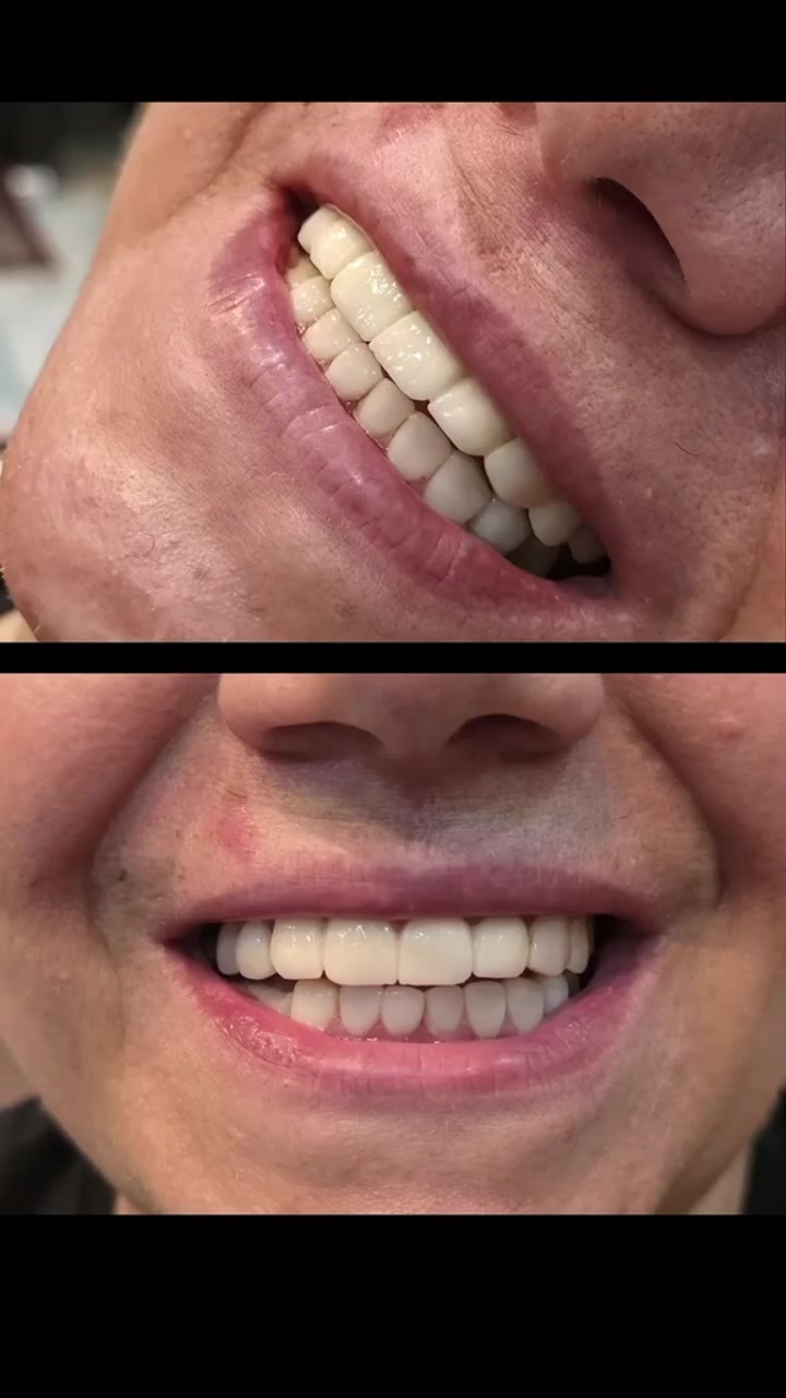 ابتسامة بتغيير شامل ✨🦷

من ابتسامة تحتاج عناية وترميم، إلى ابتسامة مرتبة ومتناسقة وأكثر إشراقاً 🤍

تغيير شامل يصنع فرقاً واضحاً في شكل الابتسامة ويزيد الثقة بالنفس ✨
وفحص الأسنان مجاناً!
احجز موعدك وخلي ابتسامتك تكون أجمل تفاصيلك 🤍

العنوان البصره قضاء الفاو - سوق الفاو الجديد - مجمع الجهاد الطبي الطابق الثاني - فوق عياده د عادل عطيه .
الرقم / ***********
#ابتسامة_هوليود #الفاو #حشوات #ابتسامة #زراعة_اسنان ابتسامة_المشاهير
