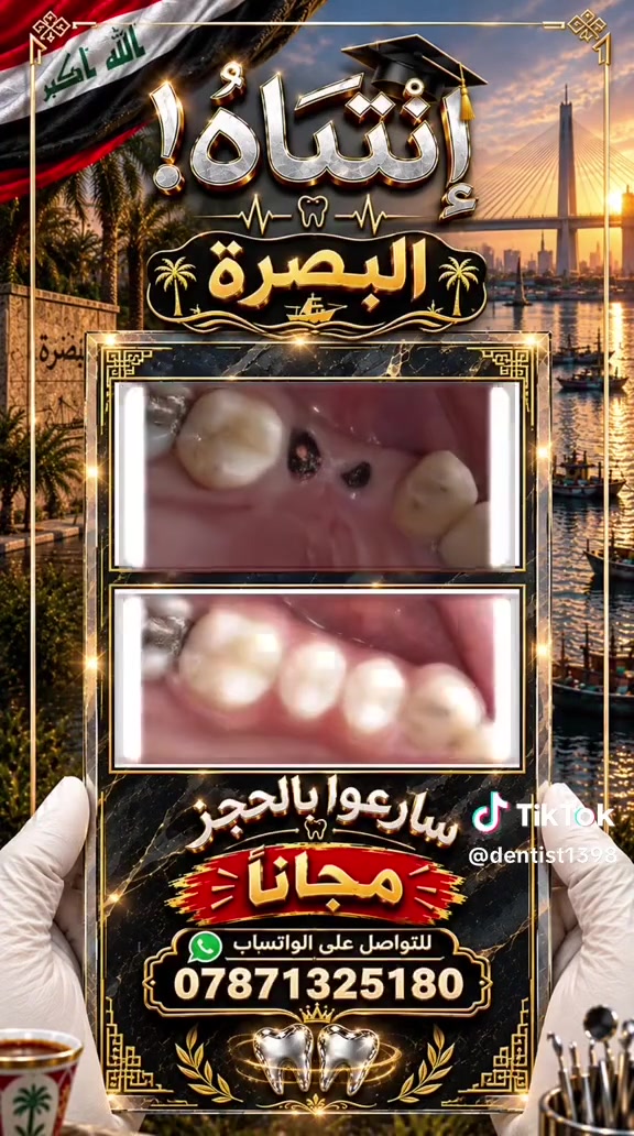 البصرة • مجاني للعوائل • علاج اسنان اطفال