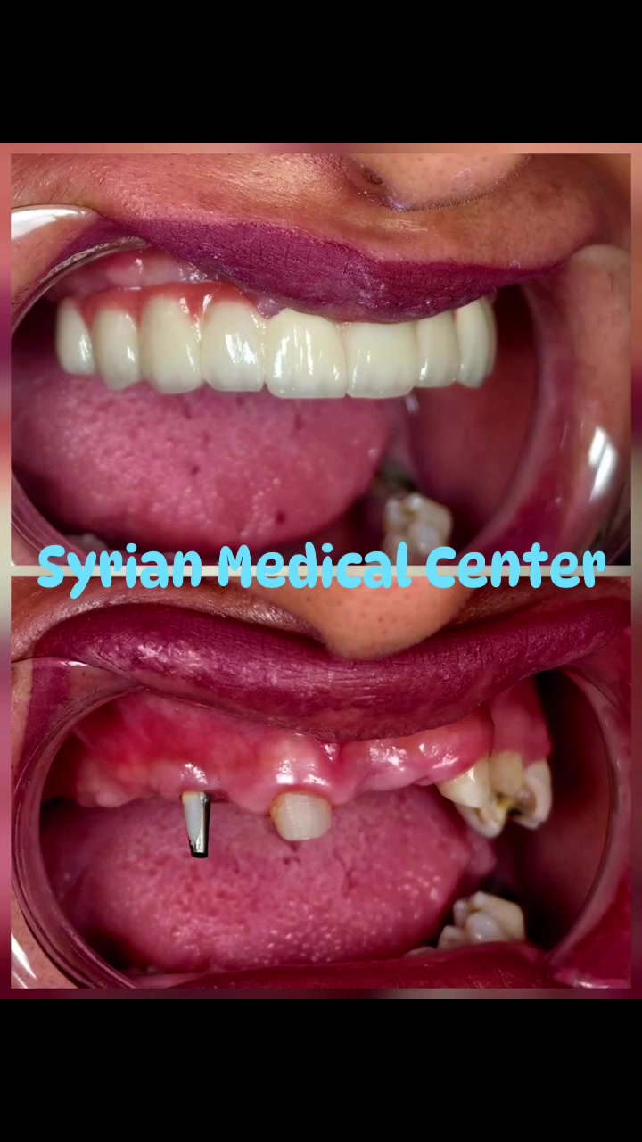 قبل الزراعة وبعد الزراعة💉💉🔥

إعاده تأهيل للفك والابتسامة والثقة للمراجعة القصه قصة تغيير حياة  وليست فقط ابتسامة  عادية ابتسم دائماً ❤️
الشغل الصح ✅ بالمكان الصح✅🫡

(زراعة-تقويم-تغليف-تركيب)

#ملاحظة ضمان مدى الحياةأدواتنا استخدام واحد فقط

المياه المستخدمة أثناء المعالج معقمة(كاسات) 

للحجز والاستفسار مراسلة الصفحة أو الاتصال على الأرقام التالية ☎️*********** _***********

#اسنان #زراعة #تقويم #تغليف
المحمودية بغداد مدينة_الصدر

تيك توك 👇👇👇
￼https://www.tiktok.com/@mstk520?_t=ZS-8vKXPDhbuIm&_r=1

انستا 👇👇👇
https://www.instagram.com/lmrkzlswryltby/
profilecard/?igsh=Y2d5ODJ5Z3YwNWl3
