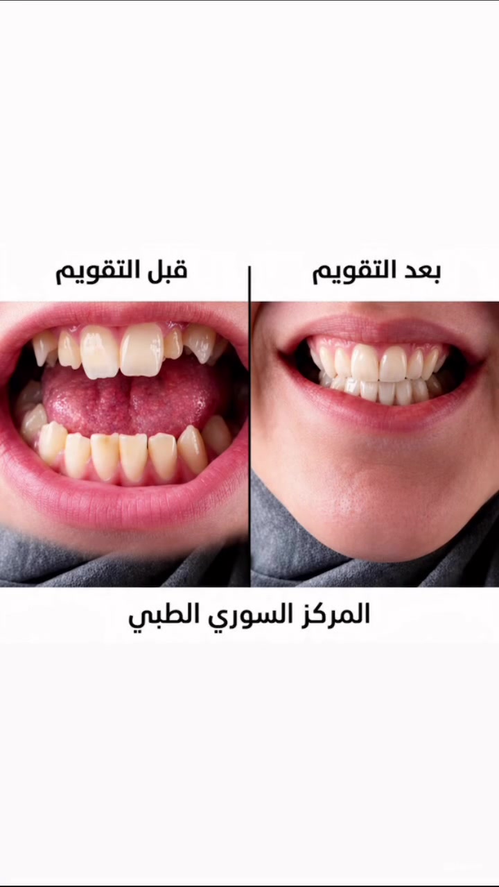 قبل التقويم وبعد التقويم ورسم ابتسامة جميلة للمراجعة القصه قصة تغيير حياة  وليست فقط ابتسامة  عادية ابتسم دائماً ❤️
الشغل الصح ✅ بالمكان الصح✅🫡

(زراعة-تقويم-تغليف-تركيب)

#ملاحظة ضمان مدى الحياةأدواتنا استخدام واحد فقط

المياه المستخدمة أثناء المعالج معقمة(كاسات) 

للحجز والاستفسار مراسلة الصفحة أو الاتصال على الأرقام التالية ☎️*********** _***********

#اسنان #زراعة #تقويم #تغليف
المحمودية بغداد مدينة_الصدر

تيك توك 👇👇👇
￼https://www.tiktok.com/@mstk520?_t=ZS-8vKXPDhbuIm&_r=1

انستا 👇👇👇
https://www.instagram.com/lmrkzlswryltby/
profilecard/?igsh=Y2d5ODJ5Z3YwNWl3
