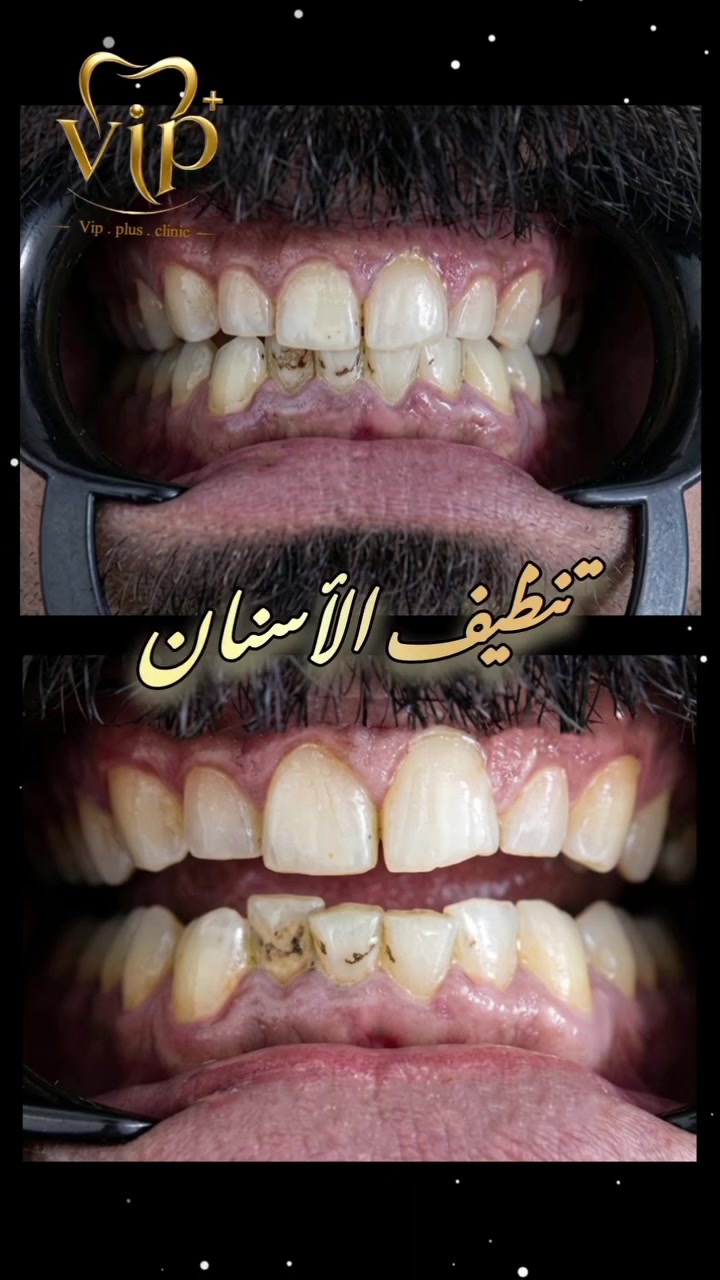 تنظيف أسنان • VIP بلس • البصرة