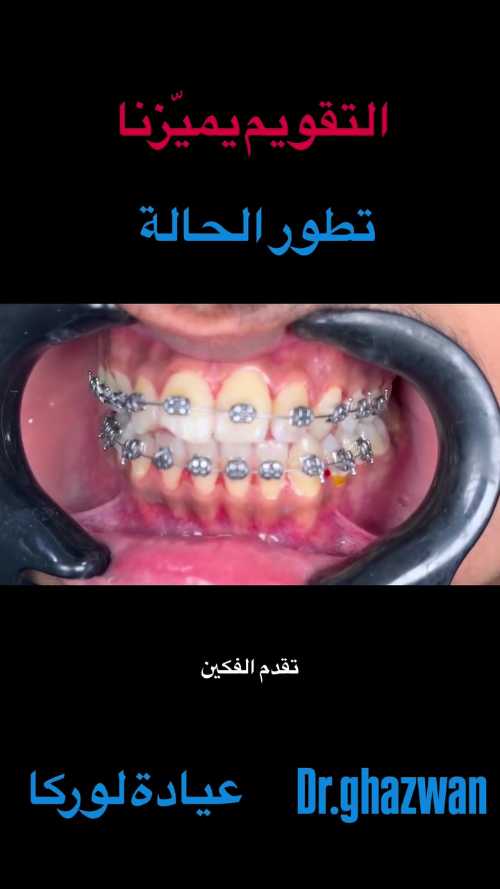 التقويم يميزنا احد حالات تقدم الفكين و عدم الانتظام … علاج جميع الحالات الصعبة و المستعصية نتائج مضمونة خبرة علمية متمكنة من الحالات الصعبة… دكتور غزوان مزهر بغداد الكرخ نفق الشرطة بداية شارع الاطباء عيادة لوركا فوق صيدلية كنز النفق متوفر واتس *********** #تقويم_الأسنان_والفكين #العضة_المعكوسة #تقدم_الفك_العلوي_السفلي #تقويم_الأسنان_قبل_وبعد #تقويم_الأسنان_بأنواعه @حشوات_الاسنان @حشوات_الجذور @تغليف_الاسنان_الزاركون
