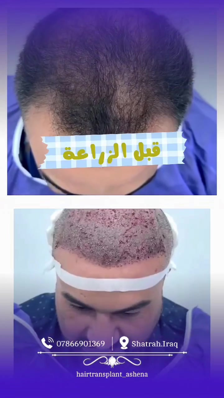 زراعة شعر • الشطرة • كادر ايراني