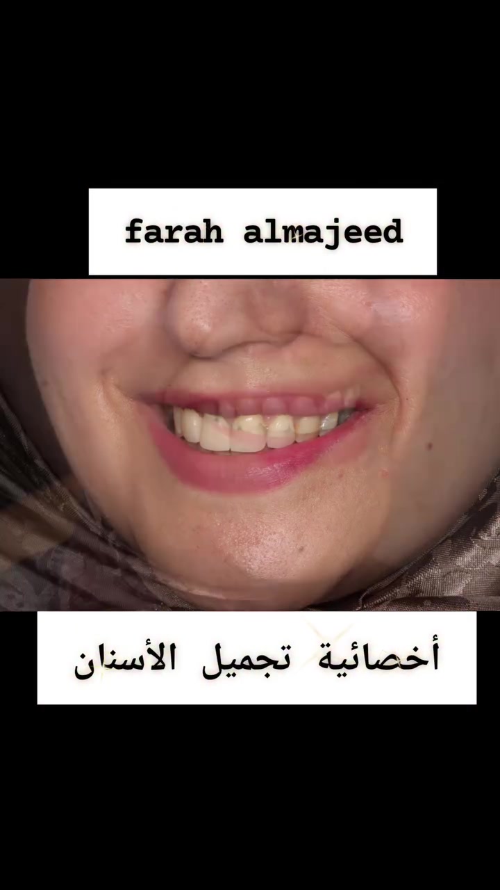 👈شنكول على جمال هاي الابتسامه ..
بيد دكتورة فرح ☺️🤩🤩😌
👈اختصاص +خبرة ١٥ سنه بالعمل المستمر ❤️
بعقوبة 🌿مدخل شفته الرئيسي
***********☎️
